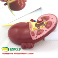 SELL 12432 Oversize Diseased Kidney Anatomy Model,1 Part, Cutaway, Anatomy Models > Urinary Models